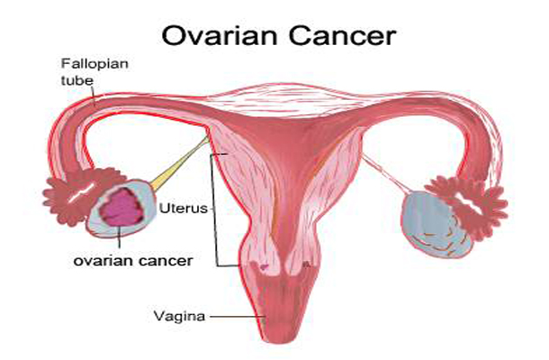 10 Early Warning Signs For Ovarian Cancer You Shouldn’t Ignore