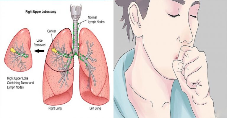 11 Warning Signs of Lung Cancer