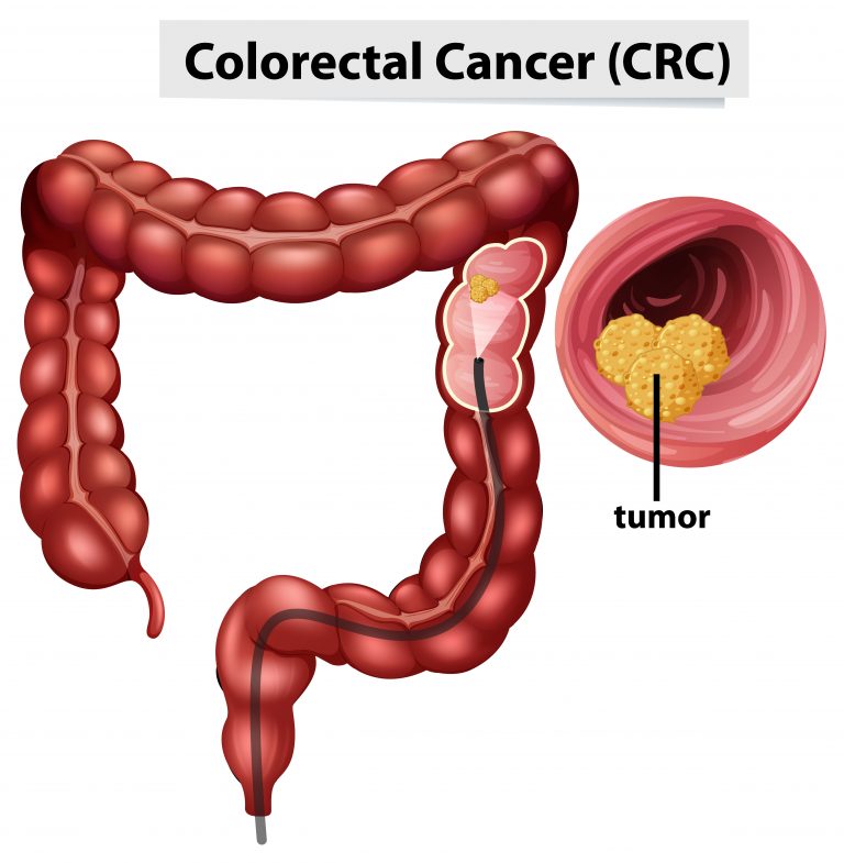 7 Warning Signs Of Colon Cancer You Shouldn’t Ignore