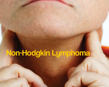 7 Things You Need To Know About Non-Hodgkin Lymphoma