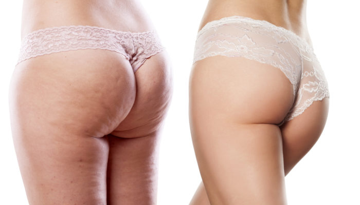 Causes Cellulite, and Can You Get Rid of It?