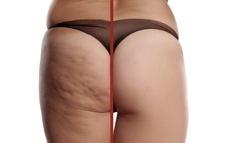 What is Cellulite | Top Viral Articles