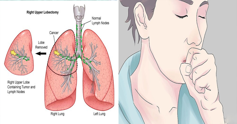 11 Warning Signs Of Lung Cancer Top Viral Articles