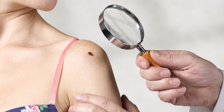 7 Facts You Need to Know About Melanoma